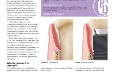 Peri-implant disease: a growing problem